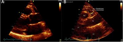 Echocardiographic Epicardial Adipose Tissue Thickness for Risk Stratification of Patients With Heart Failure